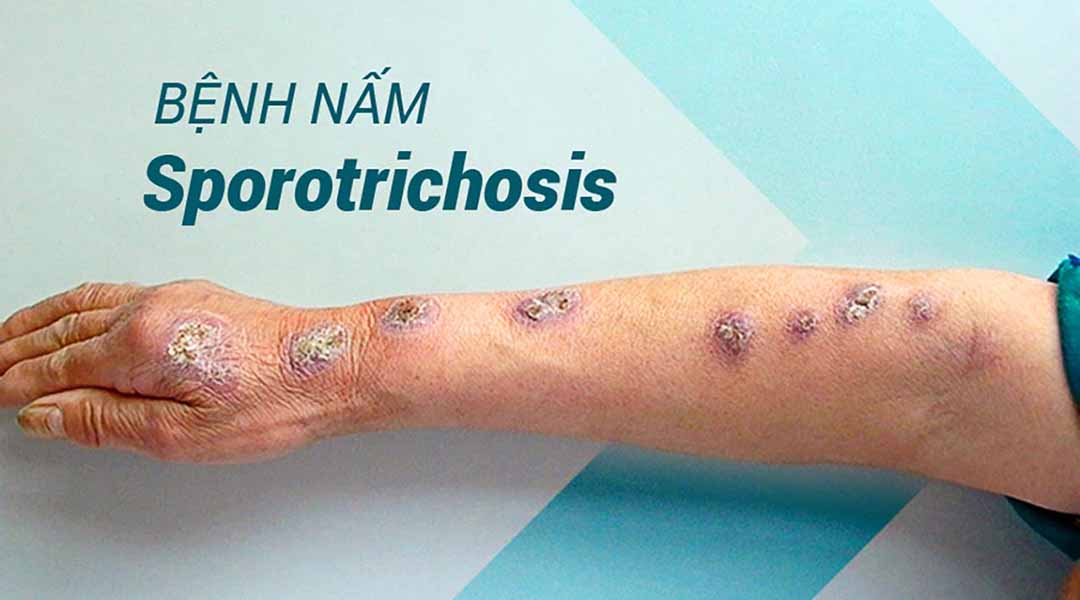 Bệnh nấm Sporotrichosis