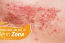 Những điều cần biết về bệnh zona