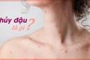 Thủy đậu là gì?