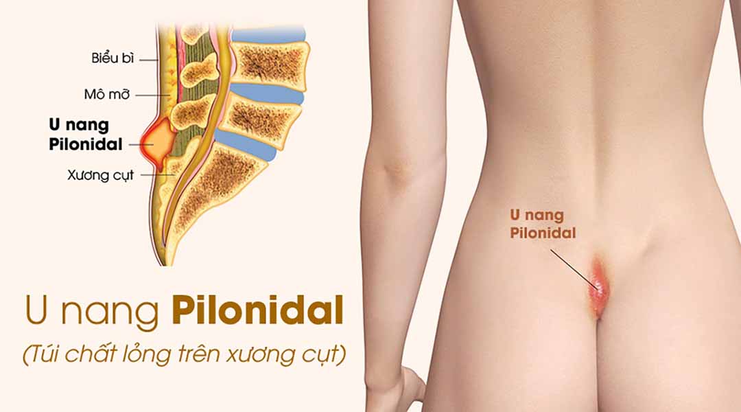 U nang Pilonidal (túi chất lỏng trên xương cụt) là gì?