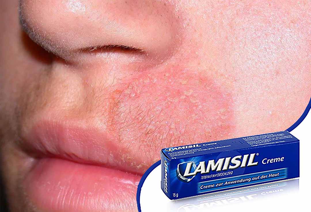Lamisil - thường được dùng để bôi lên da trị nấm da.