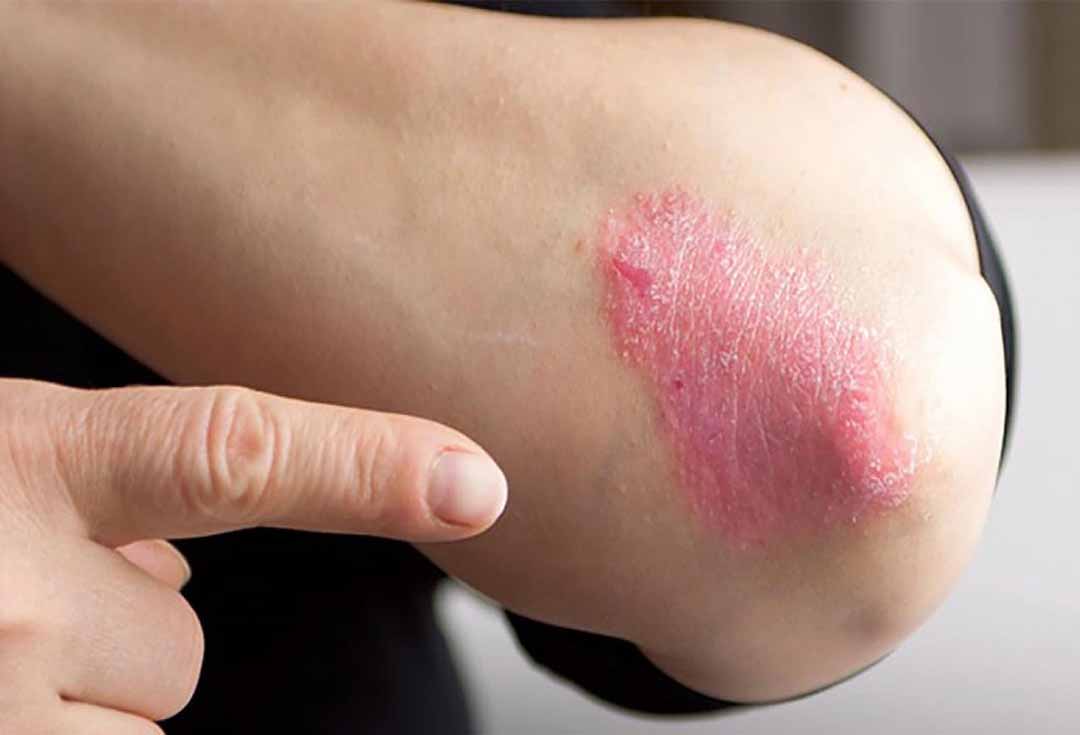 Bệnh nấm da có thể xuất hiện bất cứ nơi nào trên cơ thở với những vết loét tròn, da có vảy.
