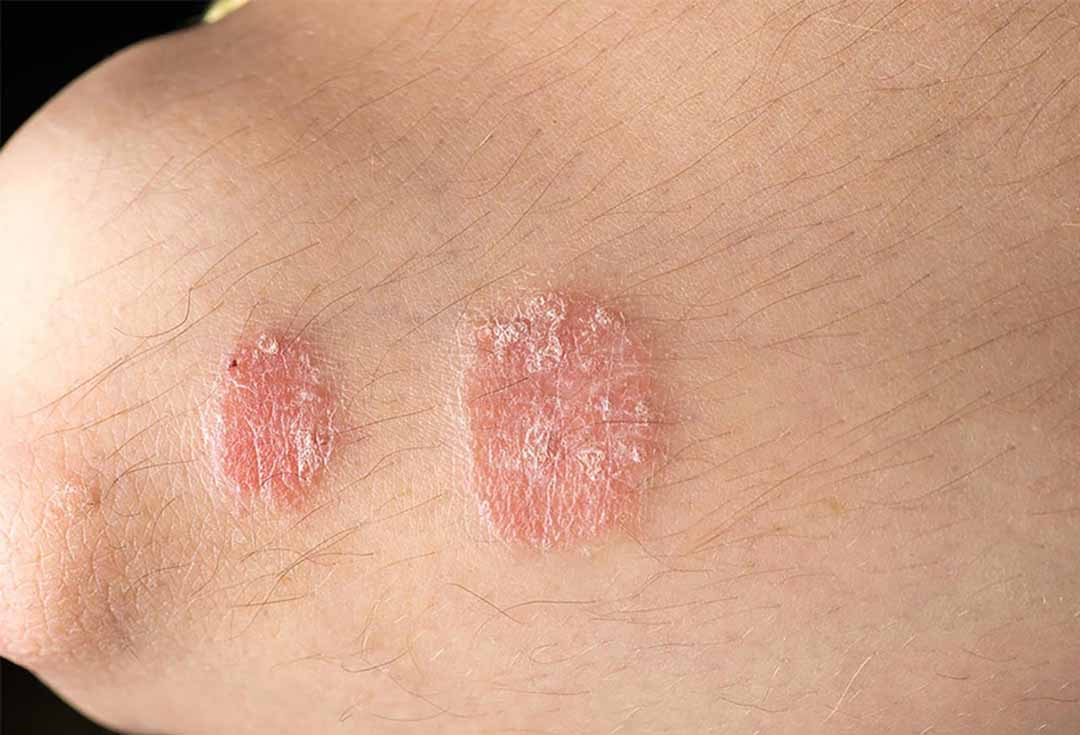 Vết loét đỏ, tròn, phẳng đôi khi đi kèm với da có vảy. Nhưng bệnh có thể xuất hiện nhiều mảng nấm da, và chúng đều có vòng đỏ nổi mẩn chồng lên nhau.