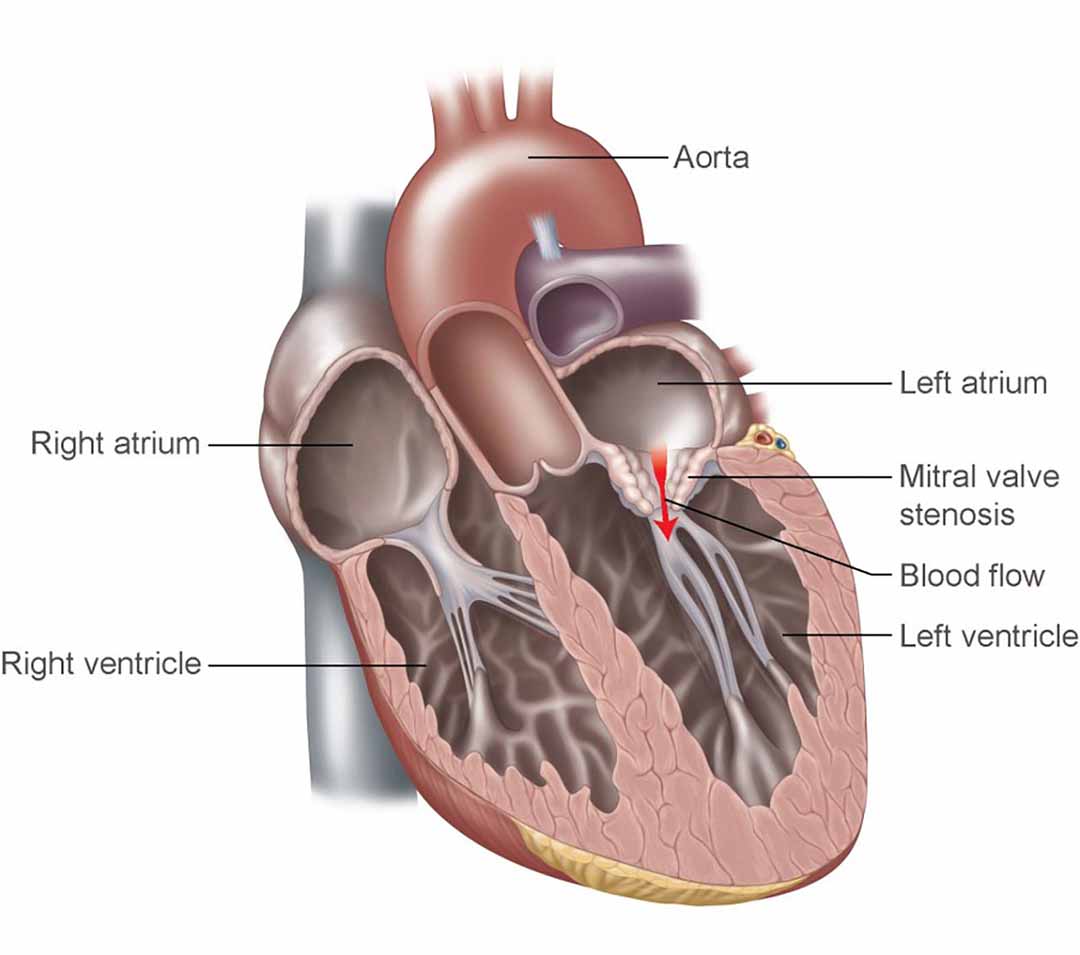 Tình trạng mà van hai lá ở tim thu nhỏ dần dẫn đến tình trạng bị hẹp của van hai lá.