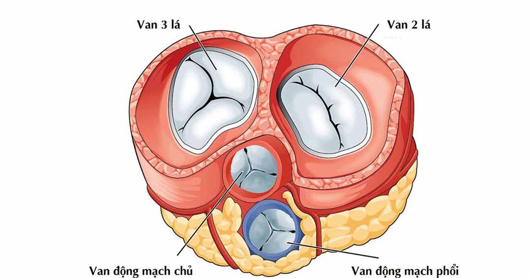 Hẹp van tim ba lá, là khi van ở tim đóng lại không chặt (bị hở).