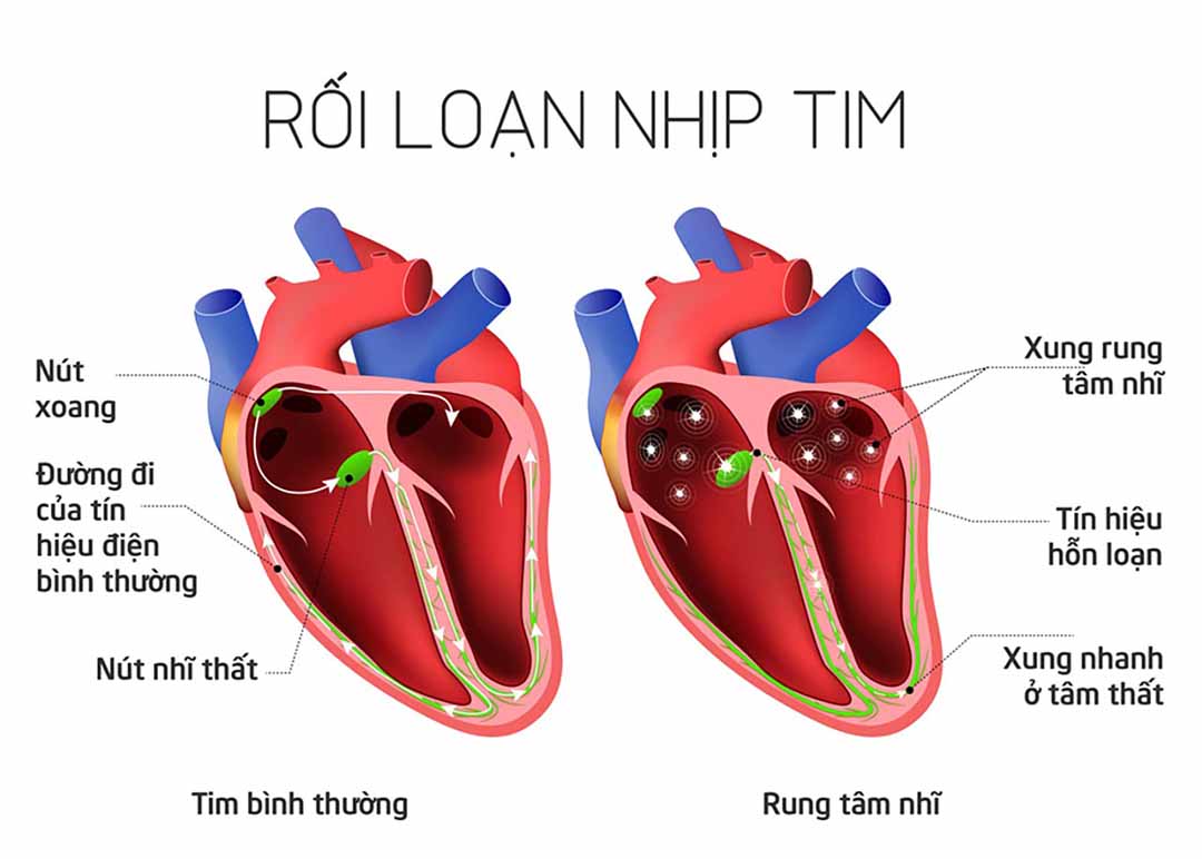 Bệnh tim đặc trưng bởi tần số hoặc nhịp tim bất thường.