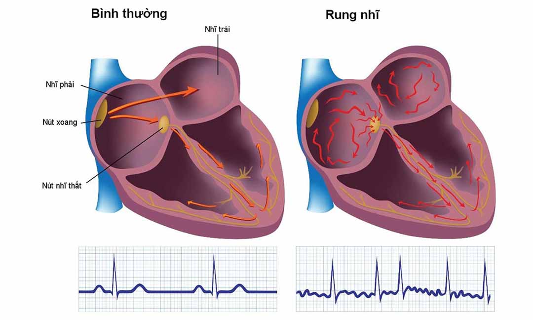 Tình trạng này có thể làm gia tăng nguy cơ đột quỵ.