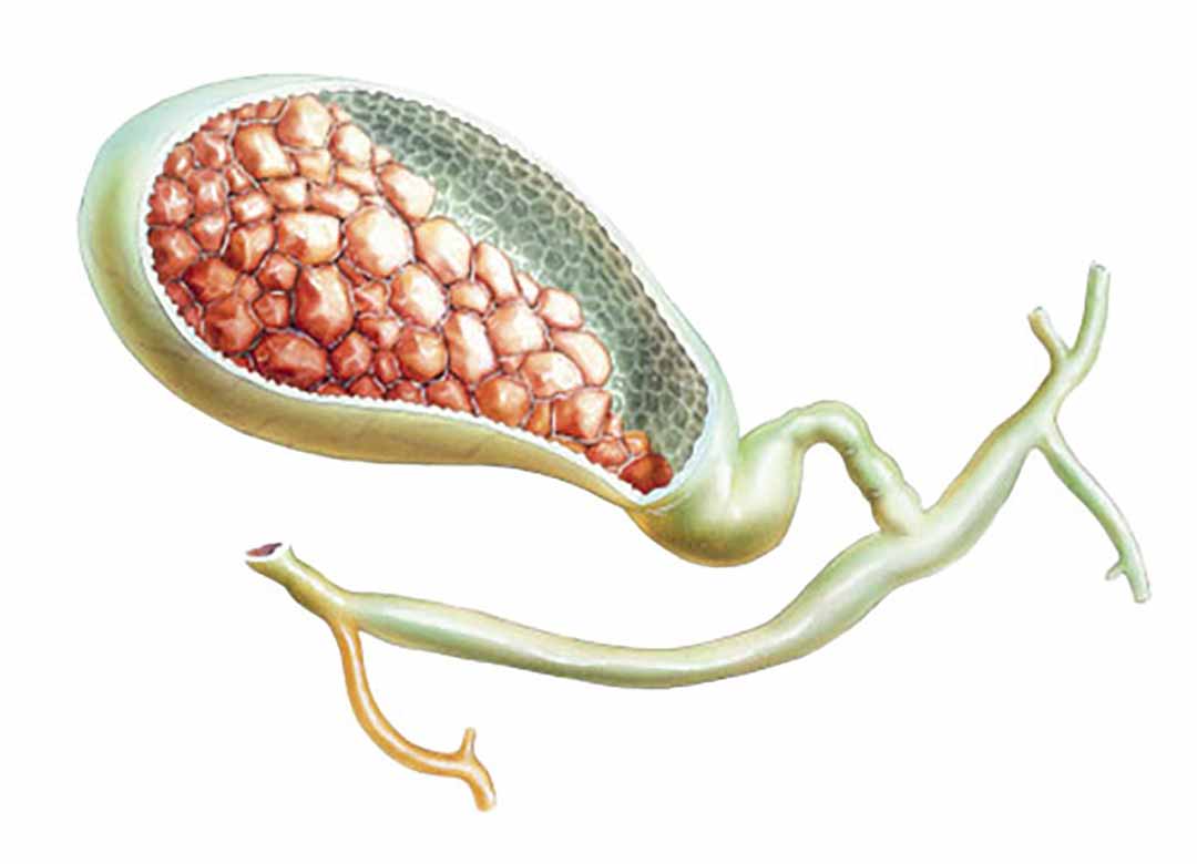 Những chất cặn lắng dạng rắn của dịch tiêu hóa có thể hình thành trong túi mật.