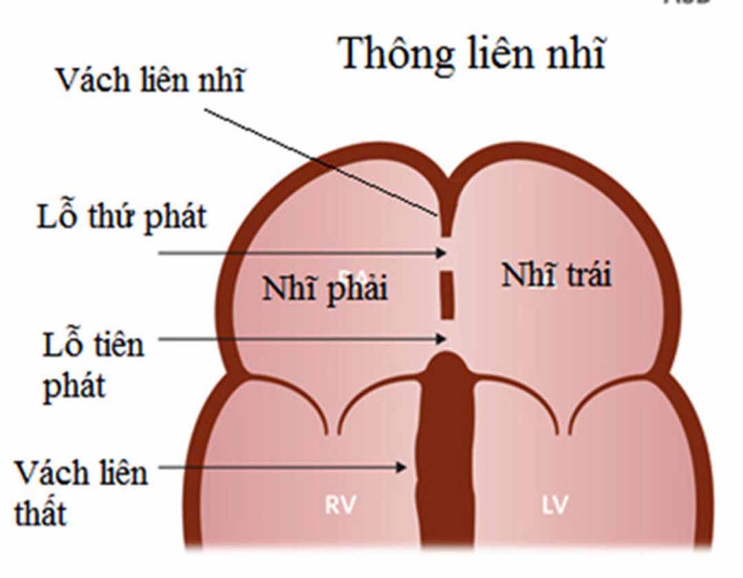 Một dị tật tim bẩm sinh có lỗ thông giữa hai buồng tâm nhĩ.