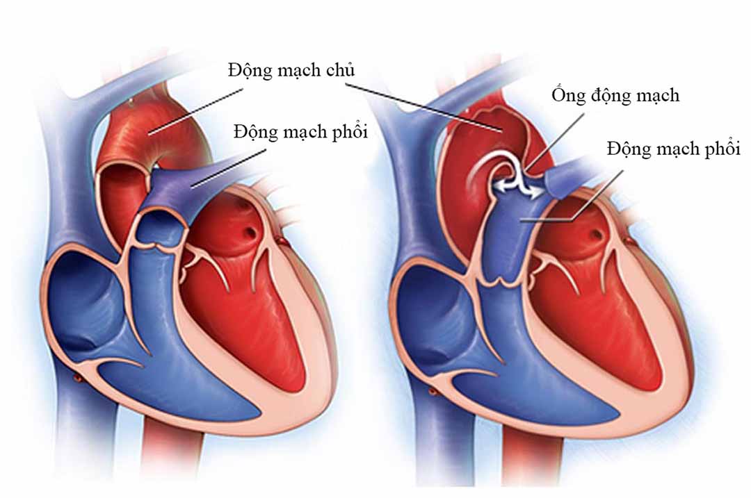 Ở người lớn do bị viêm nội tâm mạc.