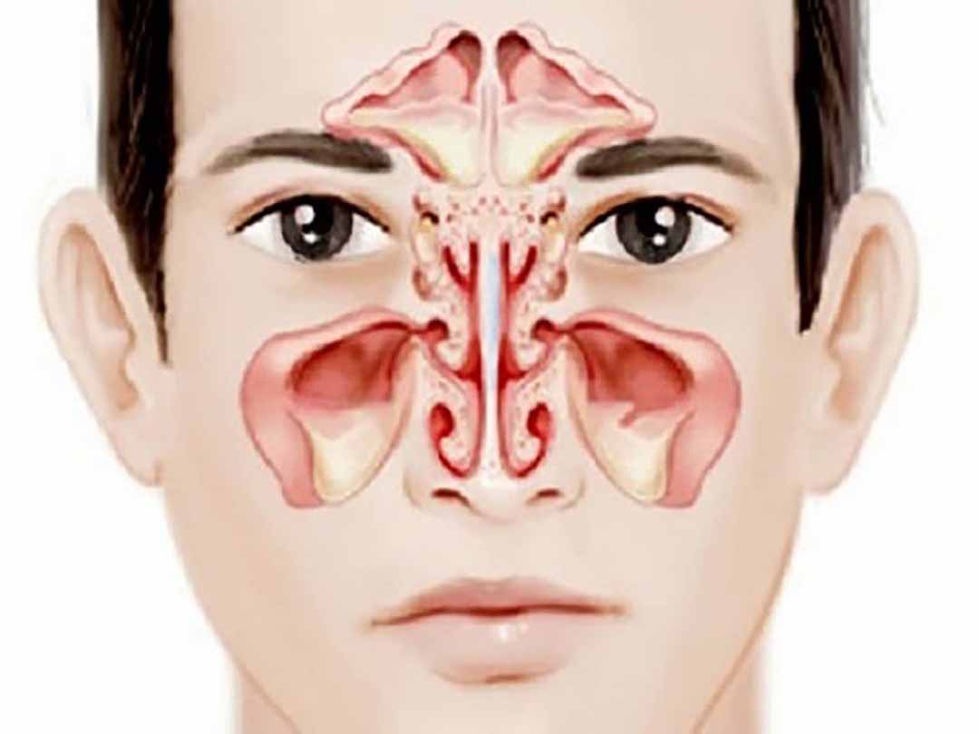 nguyên nhân gây ra căn bệnh trên có thể là vi khuẩn, dị ứng, ô nhiễm hoặc polyp mũi.