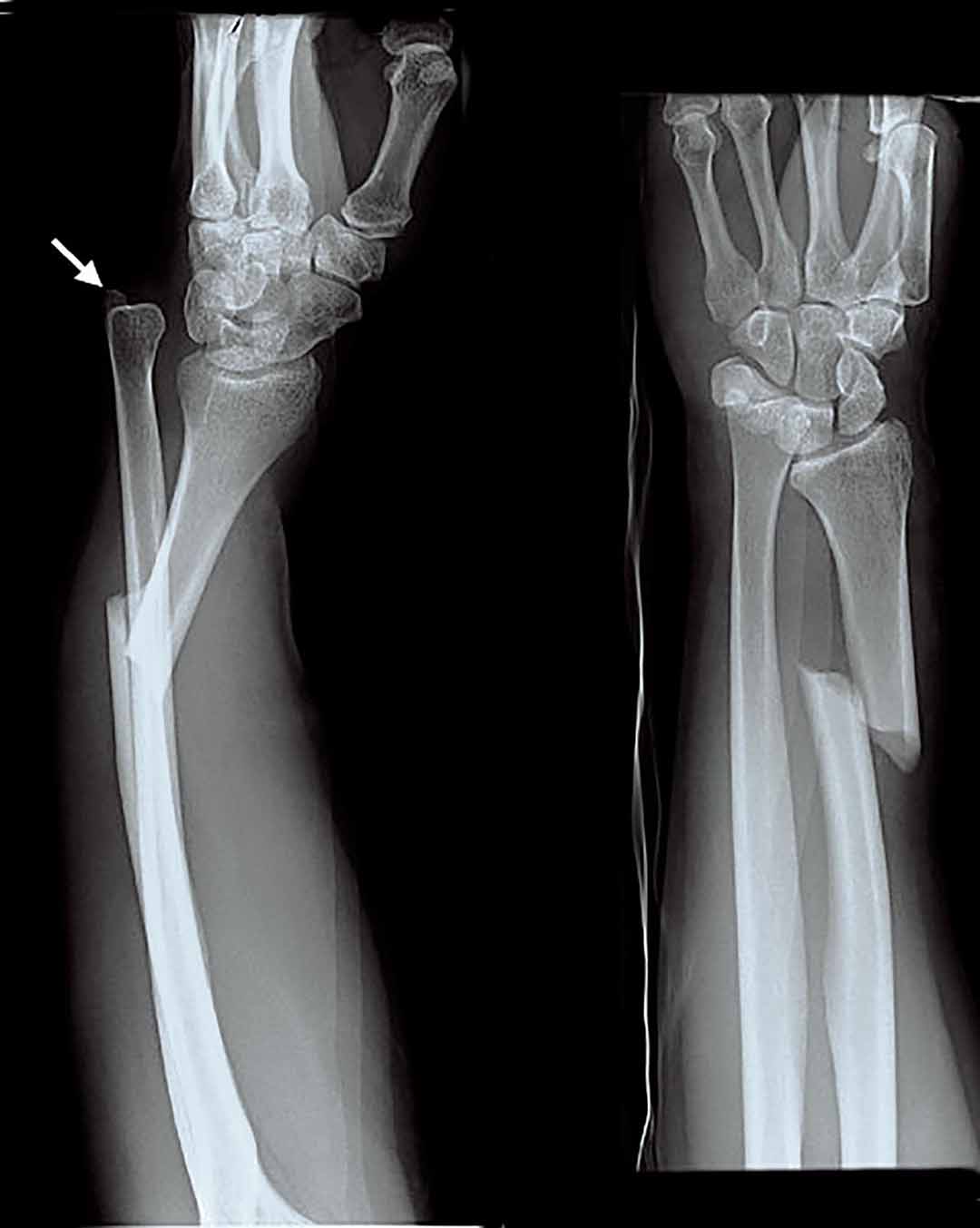 Một hoặc nhiều xương của cánh tay bị nứt.