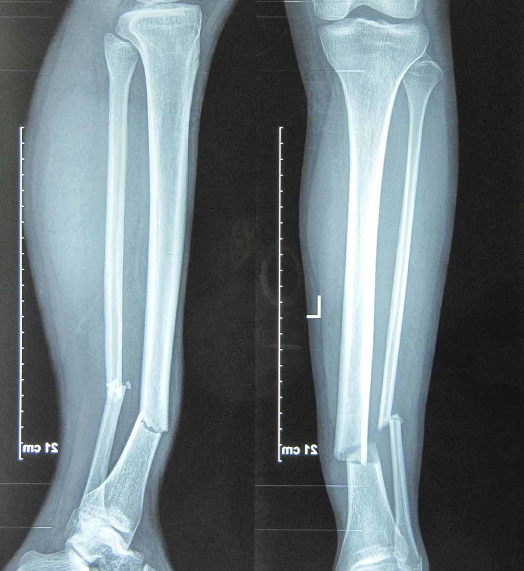 Gãy chân là tình trạng xuất hiện vết nứt hoặc gãy một trong những xương ở chân.