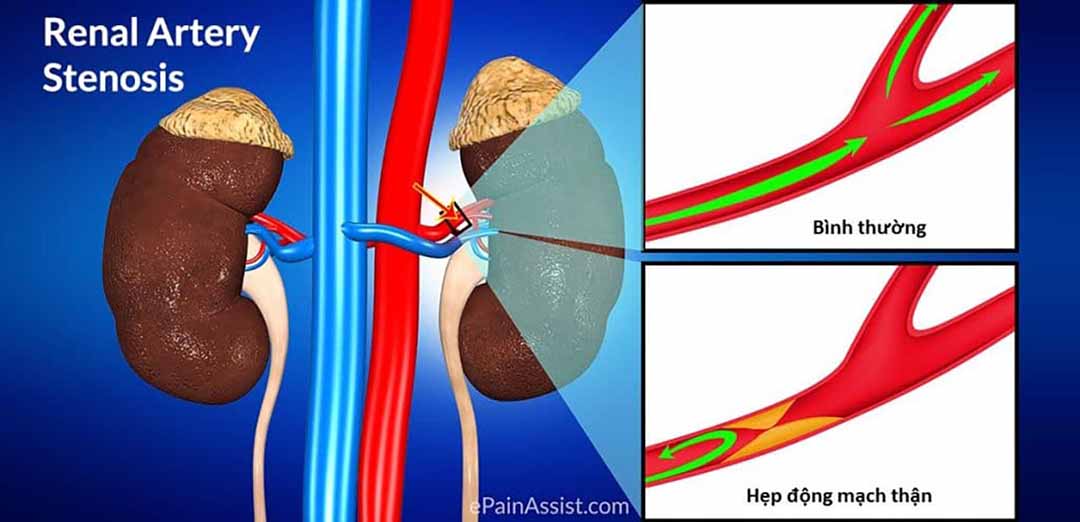 Một hoặc nhiều động mạch đến thận bị hẹp (động mạch thận).