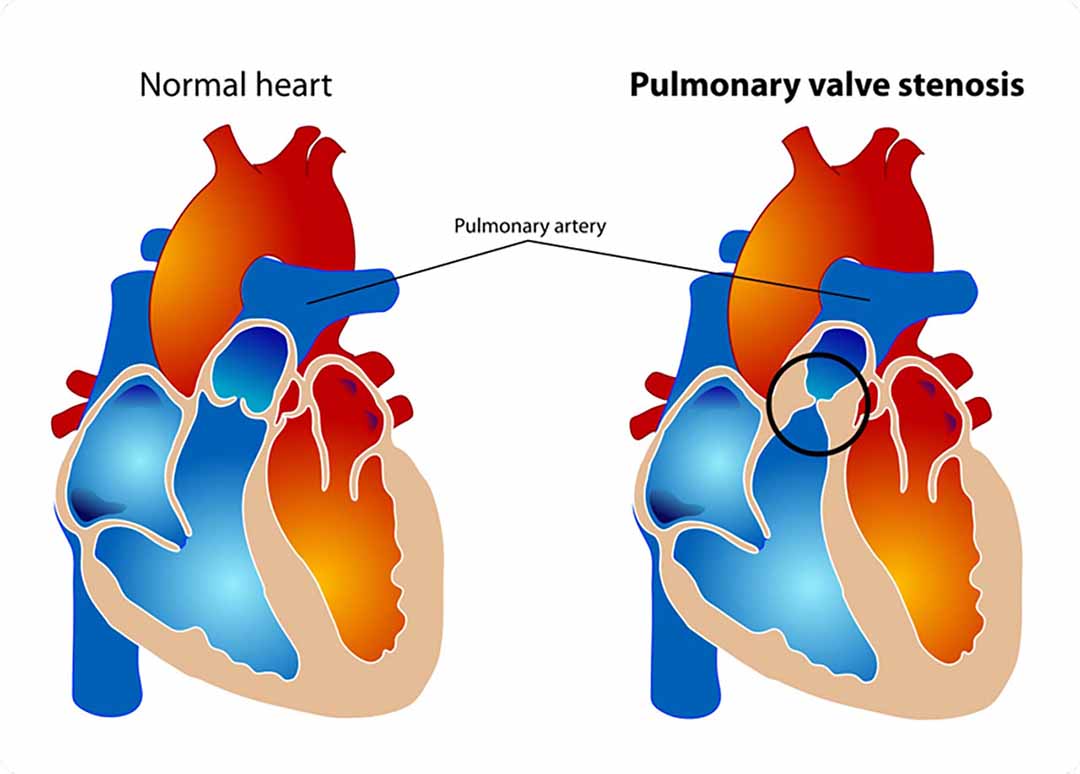 Tình trạng biến dạng trên hoặc gần van động mạch phổi.
