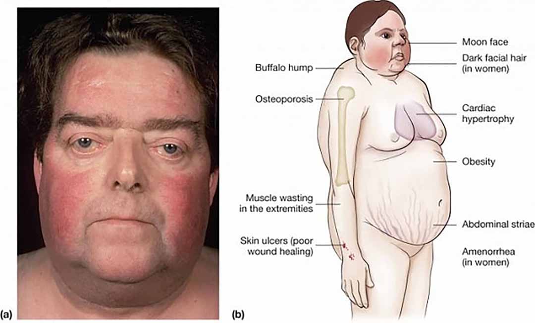 Hội chứng Cushing rất đa dạng nhưng đa số các trường hợp mắc bệnh thường bị béo phì.