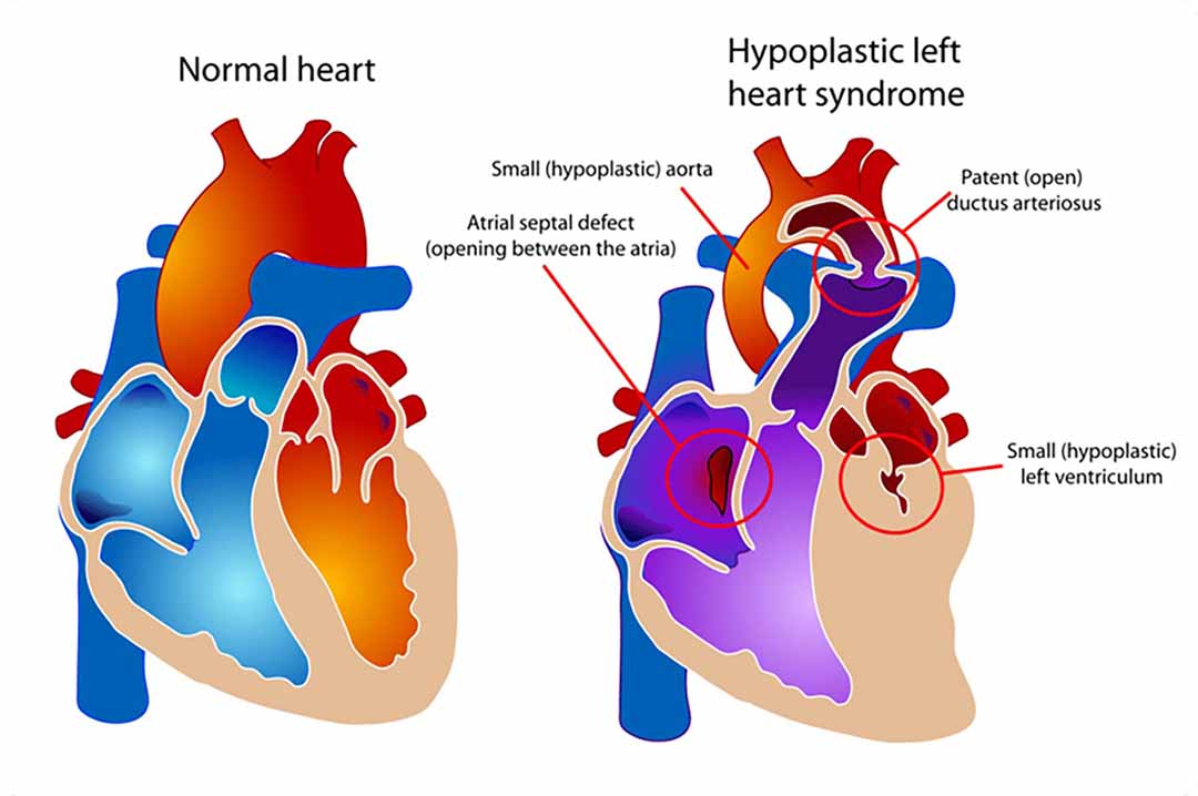 Một khiếm khuyết phức tạp và hiếm gặp ở tim xuất hiện từ khi mới sinh.