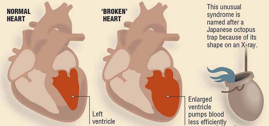 Một bệnh tim tạm thời, thường xuất hiện do các trường hợp căng thẳng.