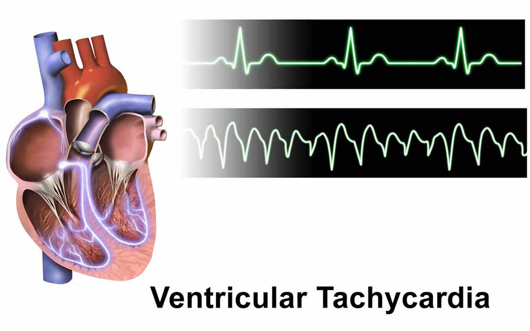 Một rối loạn nhịp tim (loạn nhịp tim) gây ra bởi các tín hiệu điện bất thường ở tâm thất của tim.