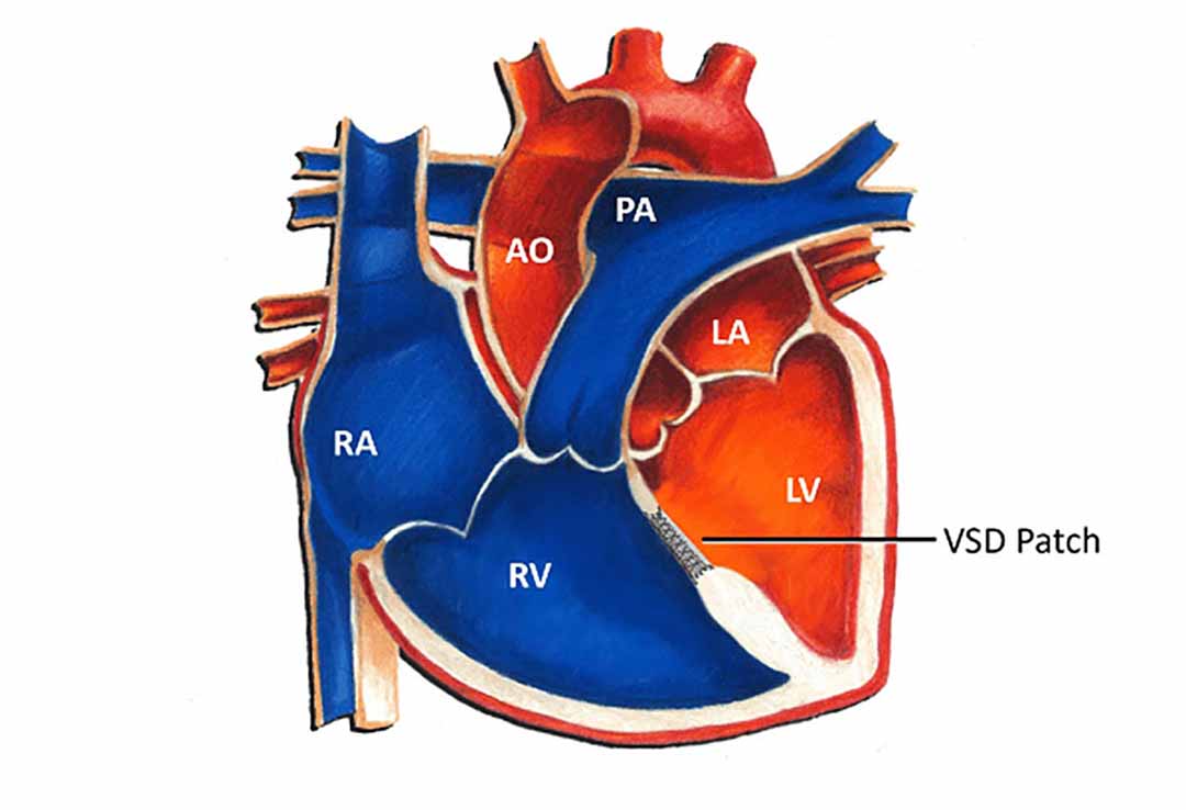 Một bệnh tim bẩm sinh thường gặp.