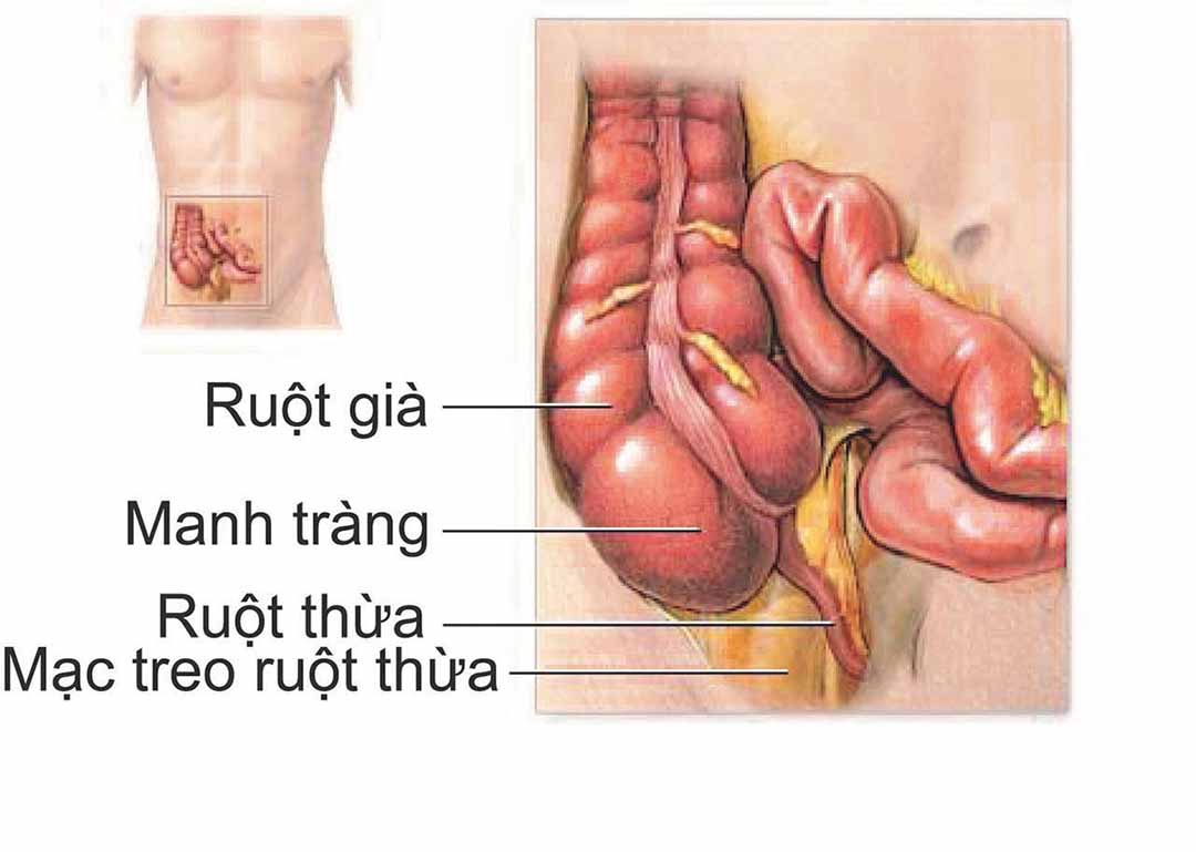 Tình trạng viêm cấp tính của ruột thừa, một cơ quan nhỏ, hình ngón tay.