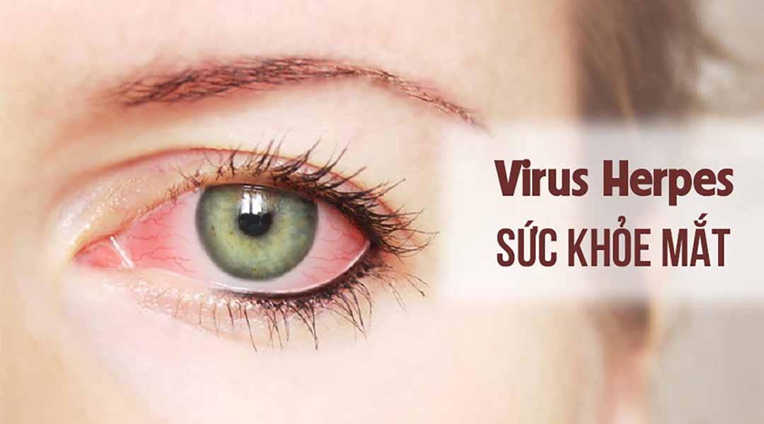 Sức khỏe mắt và Virus Herpes