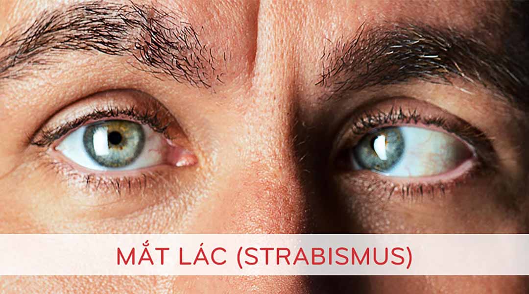 Mắt lác (Strabismus) là gì?