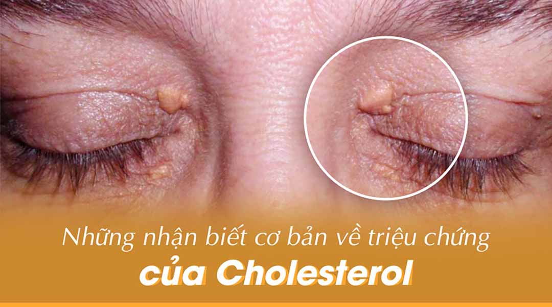 Những nhận biết cơ bản về triệu chứng của cholesterol
