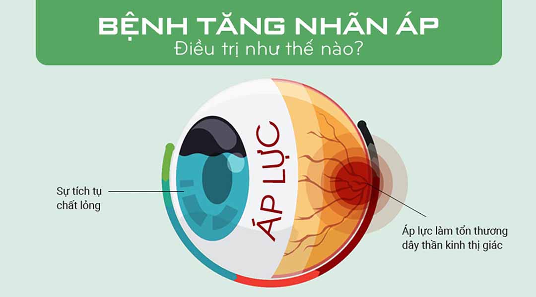 Bệnh tăng nhãn áp được điều trị như thế nào?