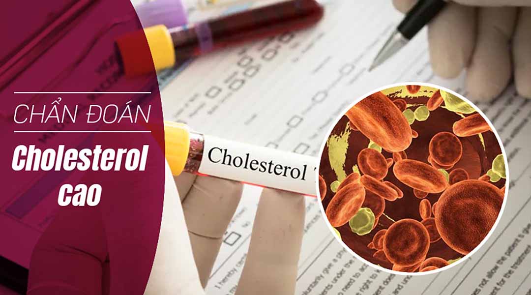Chẩn đoán Cholesterol cao