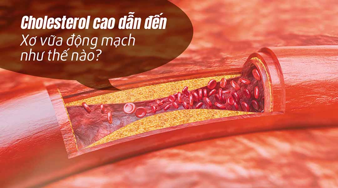 Cholesterol cao dẫn đến xơ vữa động mạch như thế nào?