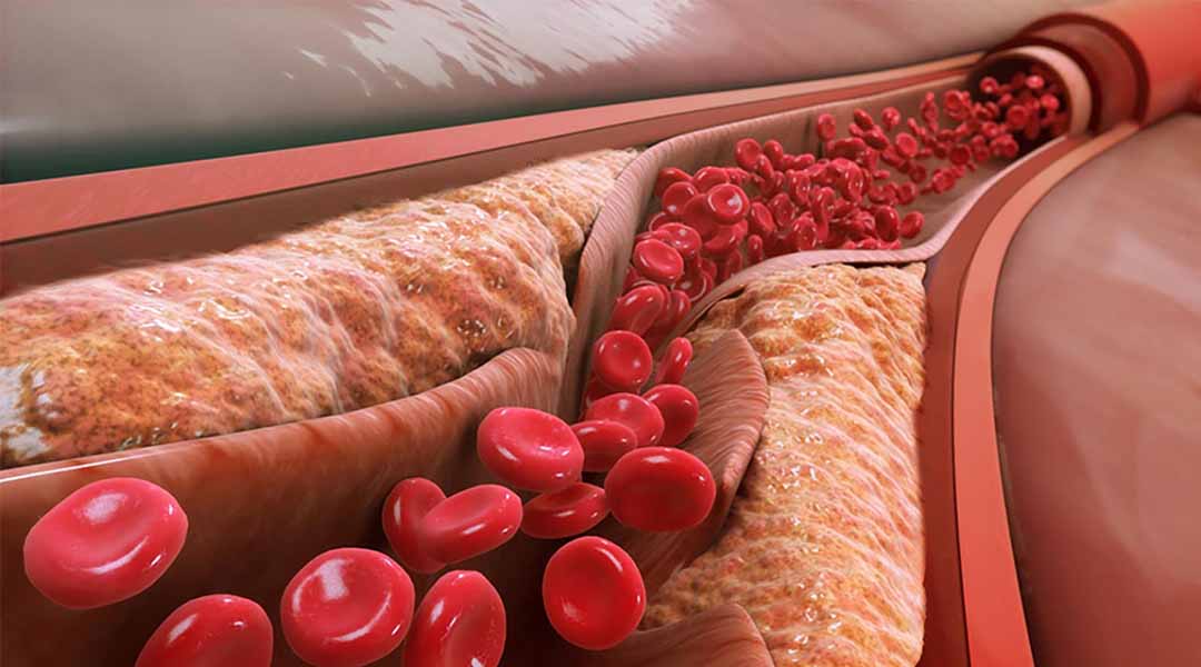 Low density lipoprotein - Lipoprotein mật độ thấp) là nguồn chính của mảng bám động mạch.