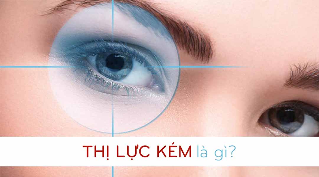 Thị lực kém là gì?