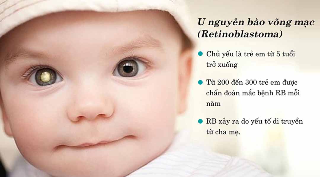 Rb xảy ra chủ yếu ở trẻ em và hầu hết là do di truyền từ cha mẹ.