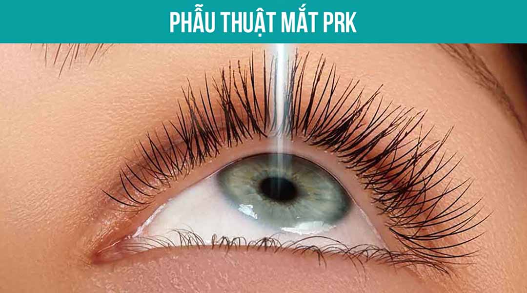 Phẫu thuật mắt bằng phương pháp Photorefractive Keratectomy (PRK)