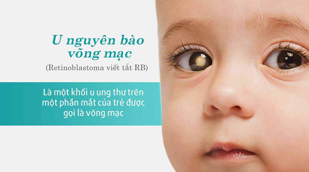 U nguyên bào võng mạc (Retinoblastoma) và mắt của con bạn