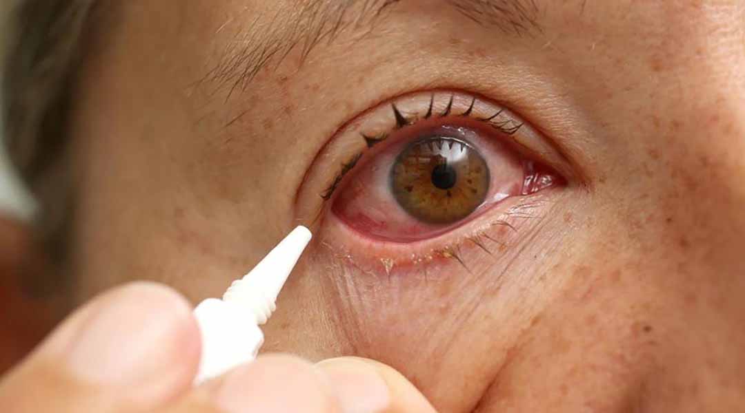 Sử dụng thuốc mỡ, thuốc nhỏ mắt hay thuốc viên phụ thuộc vào bác sĩ chỉ định cho bạn.