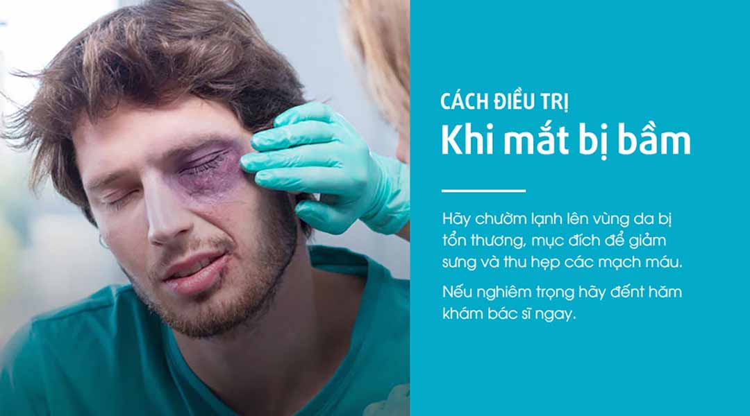 Cách điều trị khi bị bầm mắt