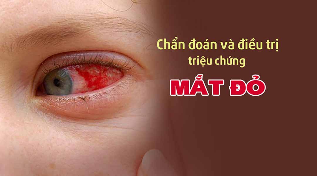 Chẩn đoán và điều trị triệu chứng mắt đỏ
