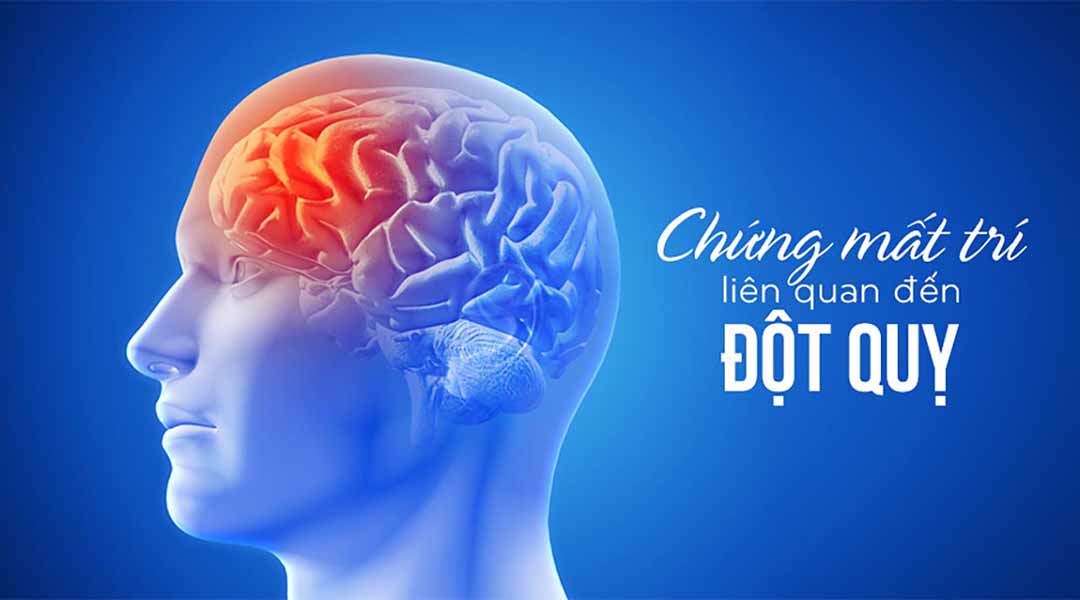 Chứng mất trí liên quan đến đột quỵ