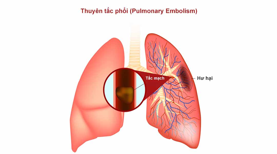 Cục máu đông hình thành sau đó hoạt động theo cách của nó trong phổi của bạn. Nó làm cho phổi không nhận được đủ máu. Điều này khiến ngực có thể bị đau.