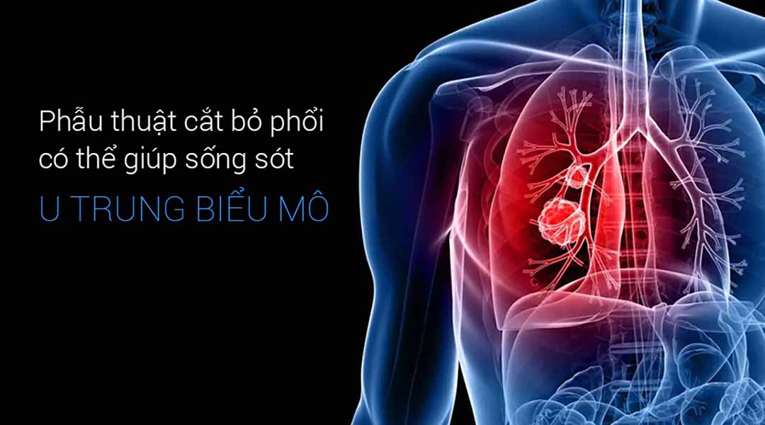 Phẫu thuật cắt bỏ phổi có thể giúp sống sót bệnh u trung biểu mô