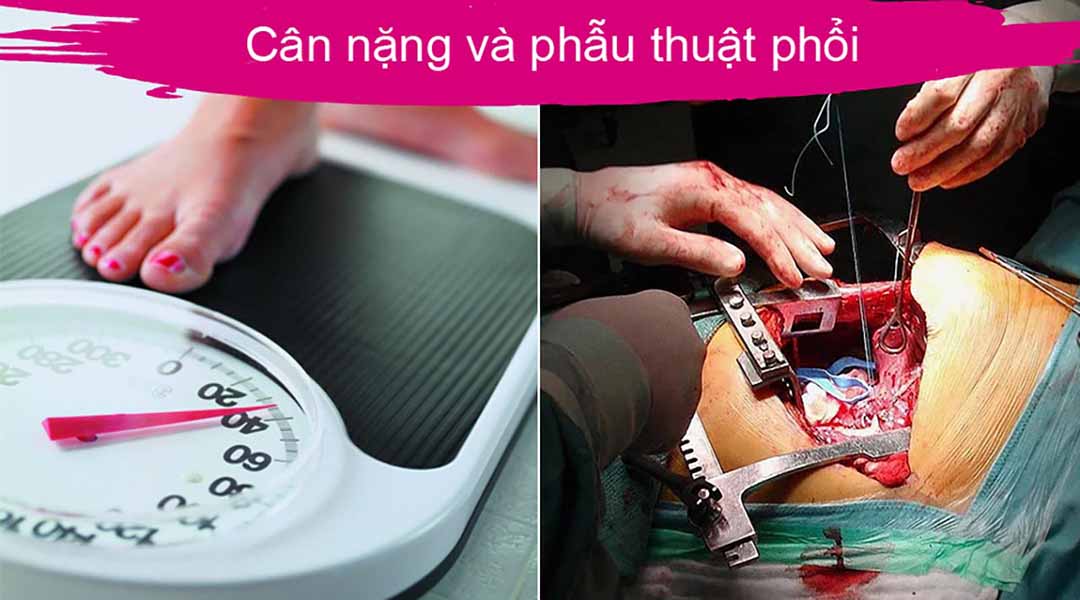 Cân nặng có thể ảnh hưởng đến phẫu thuật ung thư phổi