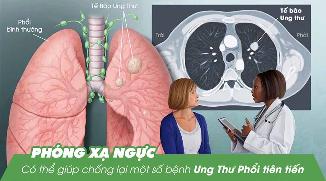 Bức xạ ngực có thể giúp chống lại một số bệnh ung thư phổi tiên tiến