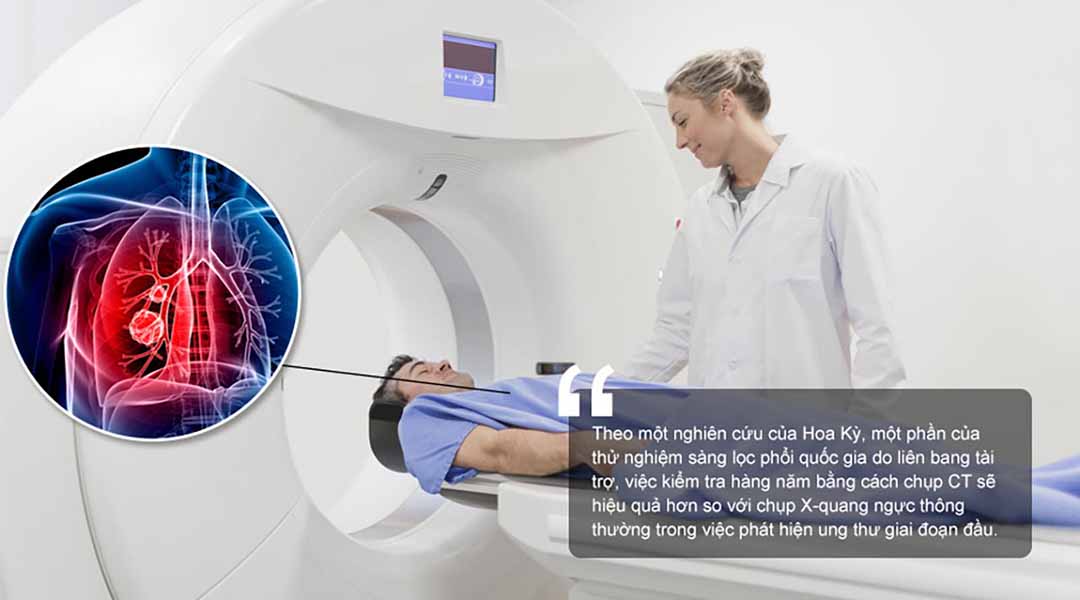 Thêm bằng chứng ủng hộ việc chụp CT định kỳ để phát hiện ung thư phổi sớm