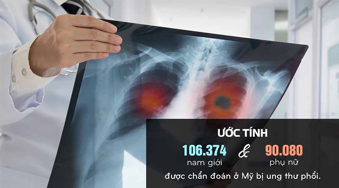 Ung thư phổi chiếm nhiều tử vong hơn ung thư đại trực tràng, tuyến tiền liệt và ung thư vú kết hợp.