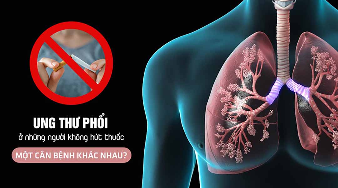 Ung thư phổi ở những người không hút thuốc: Một căn bệnh khác nhau?