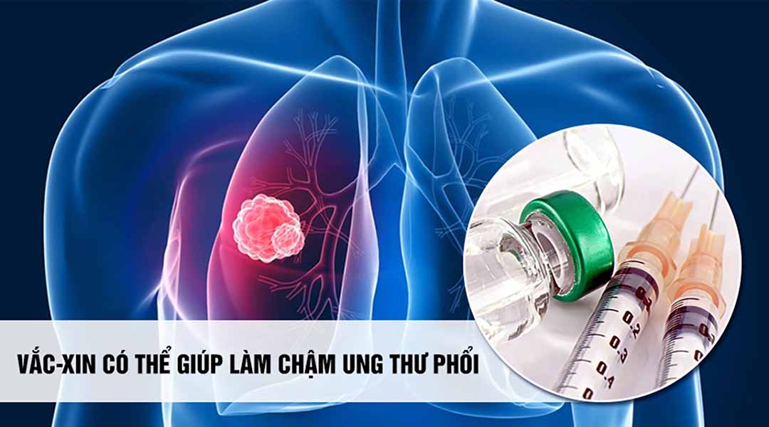 Vắc-xin có thể giúp làm chậm ung thư phổi