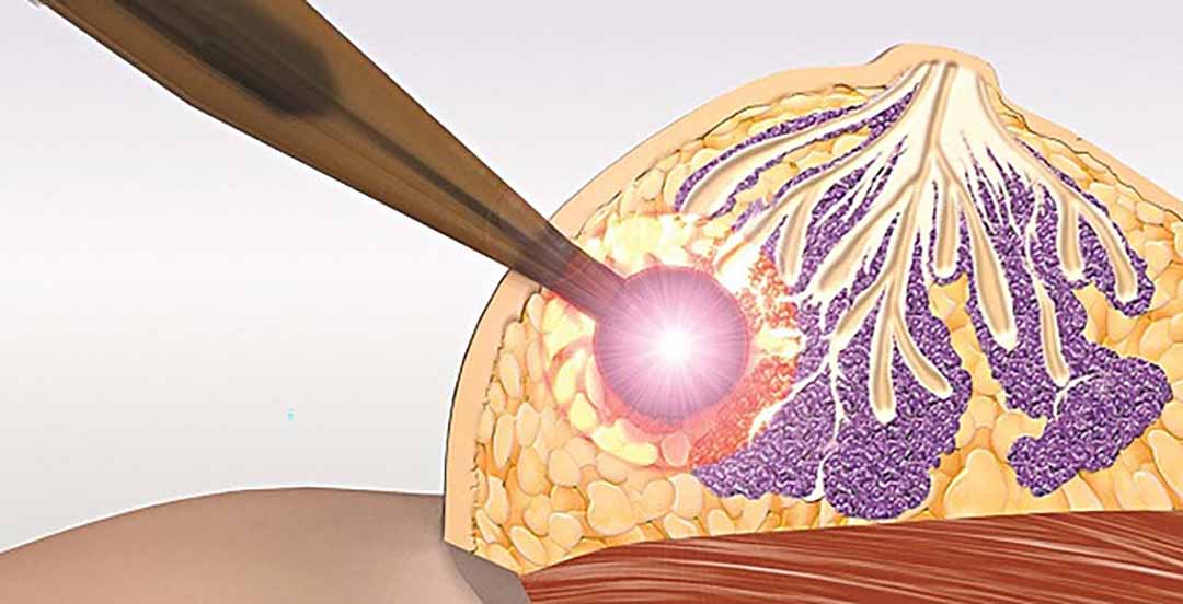 Hiện nay khoảng 90% bệnh nhân ung thư vú có thể được điều trị bằng xạ trị.