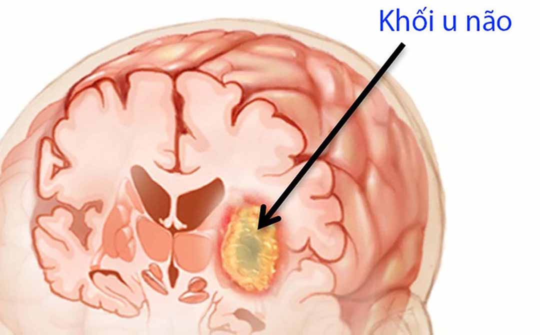 Hồ sơ phân tử dự đoán chính xác quá trình điều trị khối u ở ung thư não.